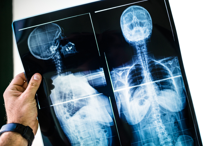 Spinal Injury Claims: Everything You Need To Know